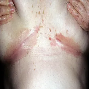 odparzenia pod biustem zdjęcia