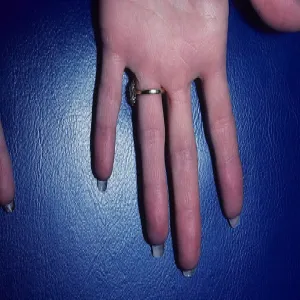 opuchnięte, zaczerwienione palce u rąk erytromelalgia