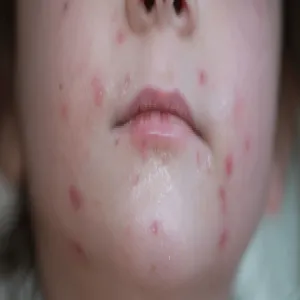 ospa u dziecka krostki na twarzy