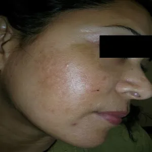 ostuda hormonalna