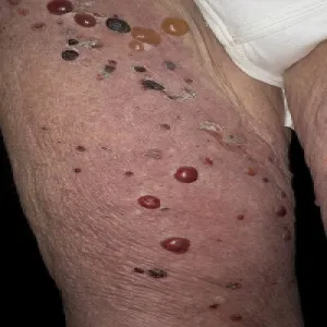 pęcherze wypełnione płynem na nogach