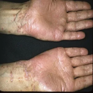 pęcherzowy liszaj płaski