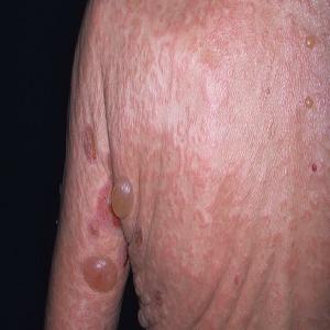 pęcherzyca choroba pemfigoid pęcherzowy