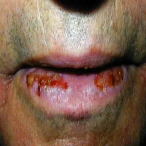pęcherzyca zwykła na ustach