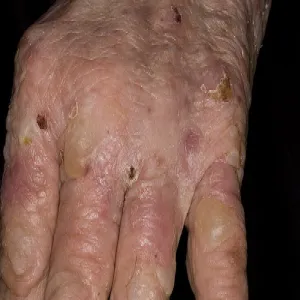 pęcherzyki na dłoniach zdjęcia