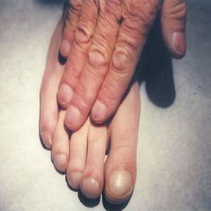 pałeczkowatość palców u rąk i nóg