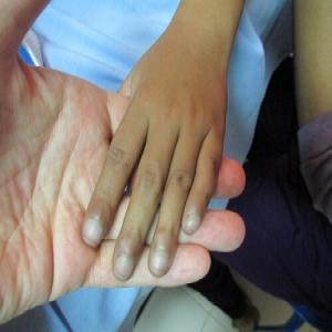 palce pałeczkowate u dzieci