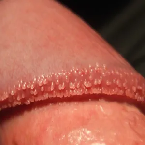 pearly penile papules