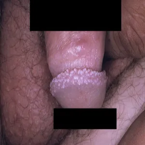 perliste grudki prącia 