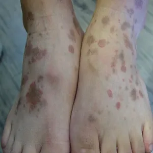 plamy na skórze stóp