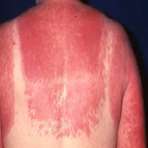 Pokrzywka po opalaniu