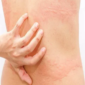 Pokrzywka słoneczna