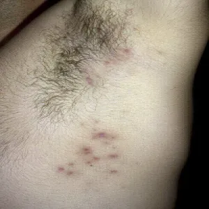 pryszcze pod pachami zapalenie mieszków włosowych