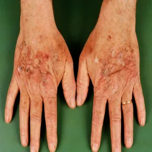 rogowacenie skóry dłoni zdjęcia