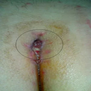 ropna krosta między pośladkami torbiel włosowa