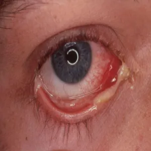 rzeżączka objawy skórne