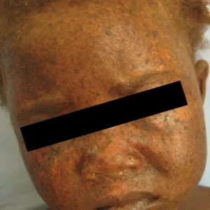 skóra pergaminowata-barwnikowa u dziecka