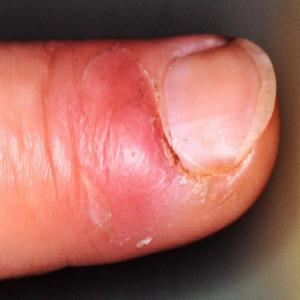 spuchnięty palec przy paznokciu
