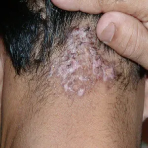 swędzące zgrubienia na głowie