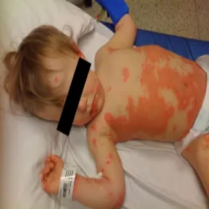 szkarlatyna u dzieci zdjęcia wysypki