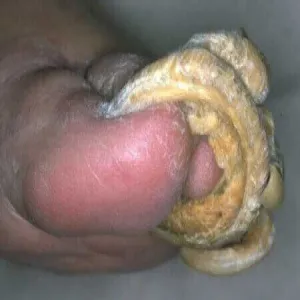 szponowate paznokcie