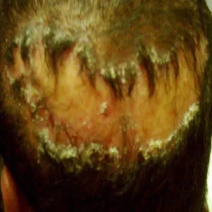 tinea favosa capitis