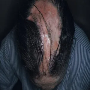 toczeń rumieniowaty na skórze głowy