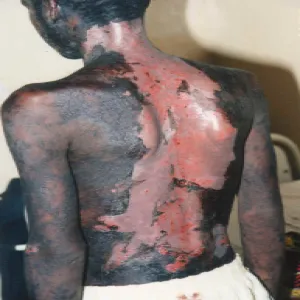 Toksyczna nekroliza naskórka zespół Lyella