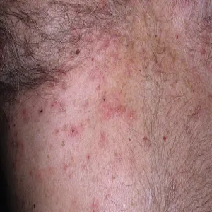 transient acantholytic dermatosis