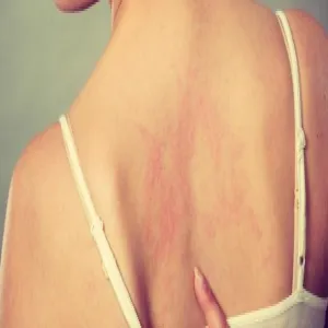 uczulenie na opalanie