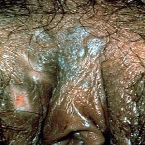 wargi sromowe choroby zdjęcia grudkowatość bowenoidalna 