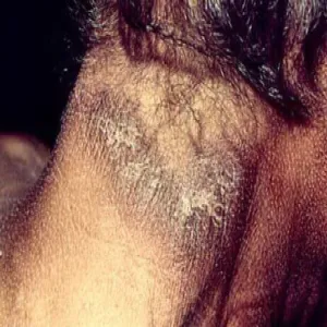 witamina pp niedobór objawy