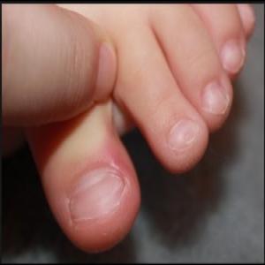wrastający paznokieć u dziecka