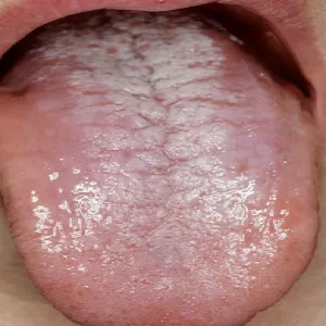 wygląd języka a choroba grzybica zdjęcie