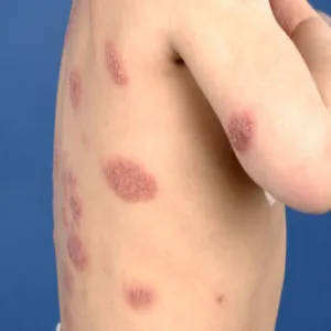 wyprysk mikrobowy u dzieci