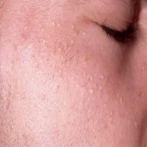 wysypka na twarzy białe krostki wągry