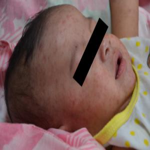 wysypka u niemowlaka na twarzy odra