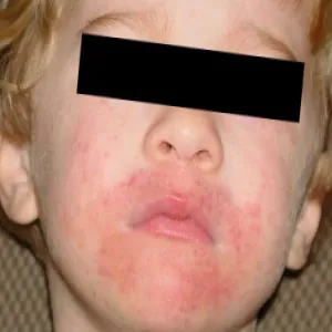 wysypka wokół ust u dziecka