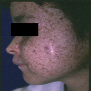 xeroderma pigmentosum 