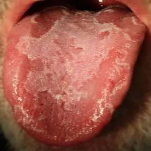 złuszczające zapalenie języka