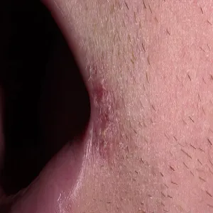 zaczerwienienie w kącikach ust