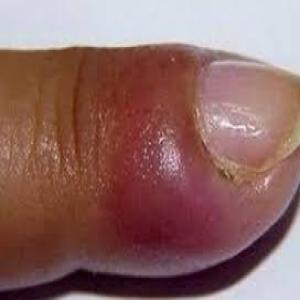 zaczerwienienie i ból wału paznokciowego