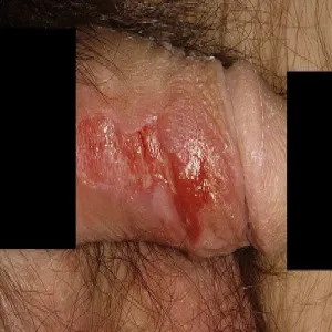 zakażenia wirusowe zapalenie napletka