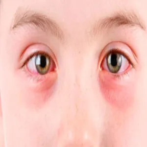 zapalenie brzegów powiek u dzieci