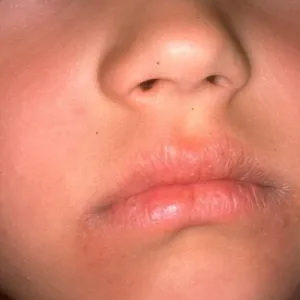 zapalenie kącików ust u dziecka