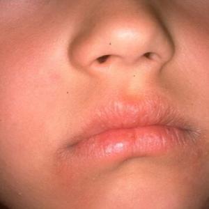 zapalenie kącików ust u dziecka