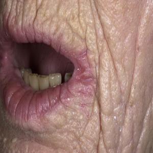 zapalenie kącików ust u osób starszych