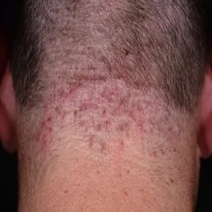 zapalenie mieszków włosowych na głowie