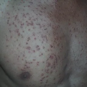 zapalenie mieszków włosowych na klatce piersiowej