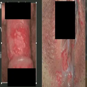 zapalenie mieszków włosowych okolic intymnych